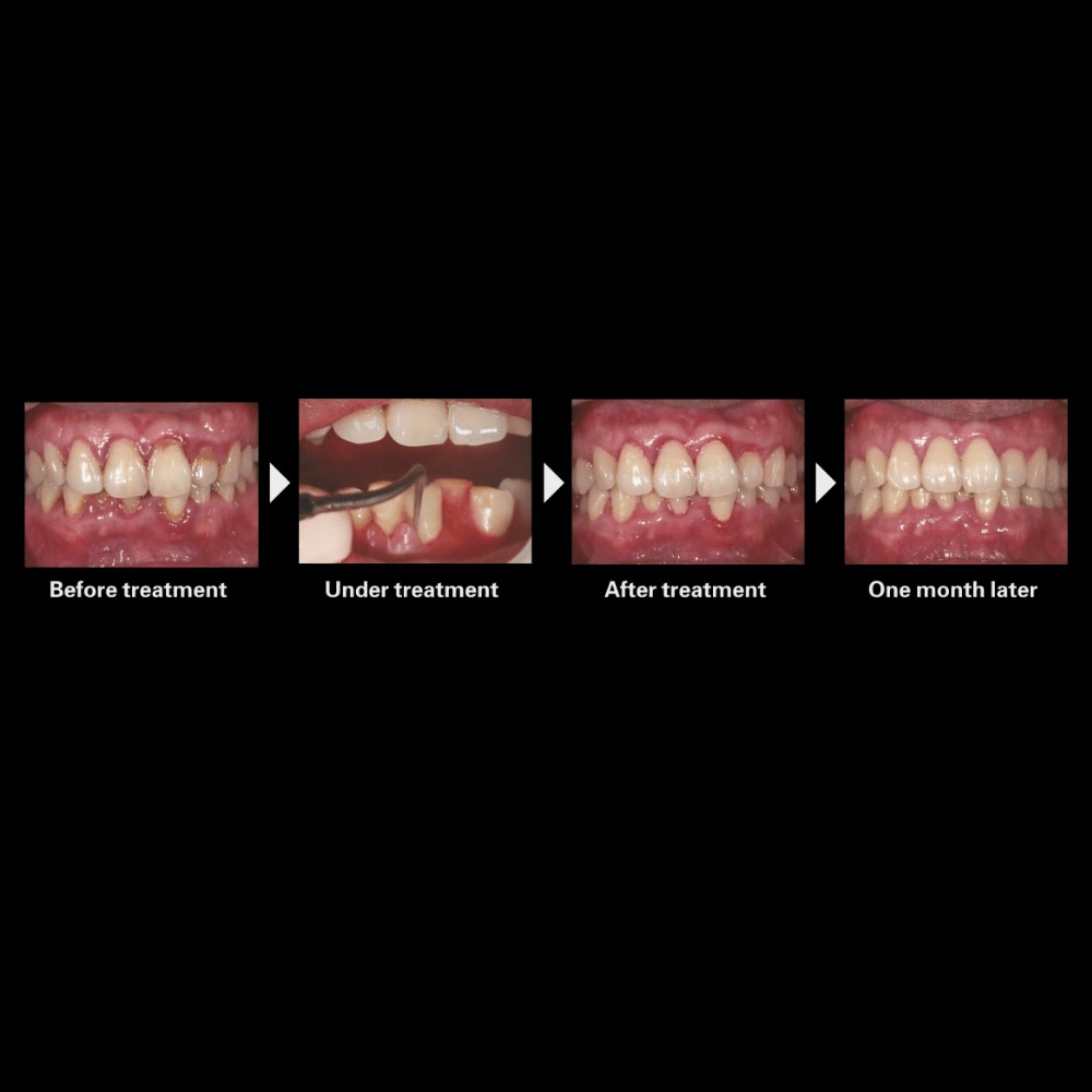 Keramik-Ultraschallgerät WP-PT-5_5